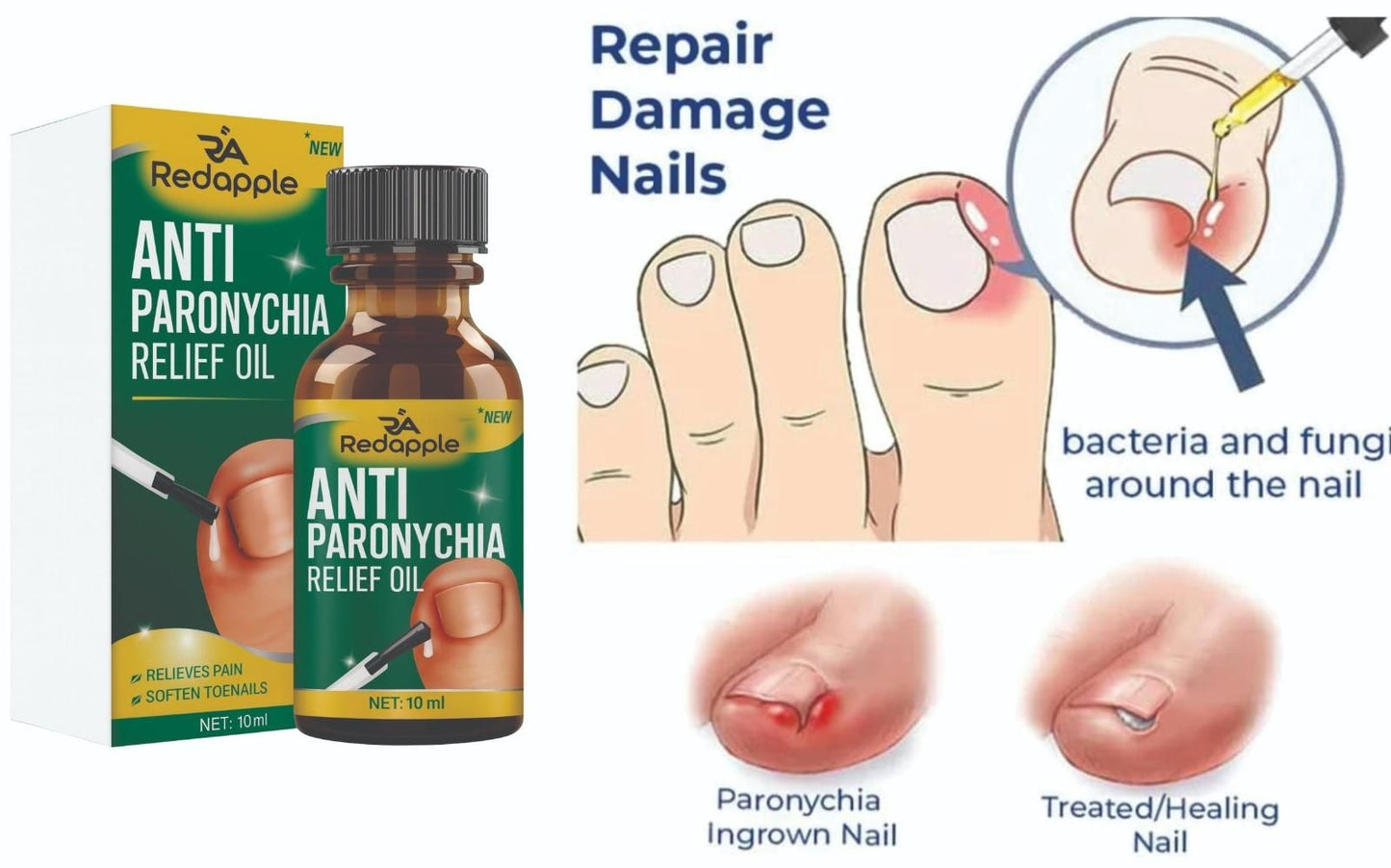 Rapid Relief Anti-Paronychia Nail Treatment Oil (20ml x 2) | Soothing Cuticle & Nail Infection Care