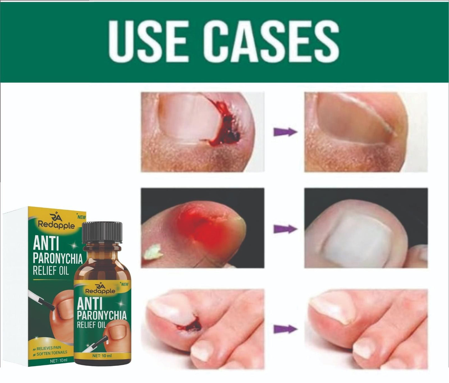 Rapid Relief Anti-Paronychia Nail Treatment Oil (20ml x 2) | Soothing Cuticle & Nail Infection Care