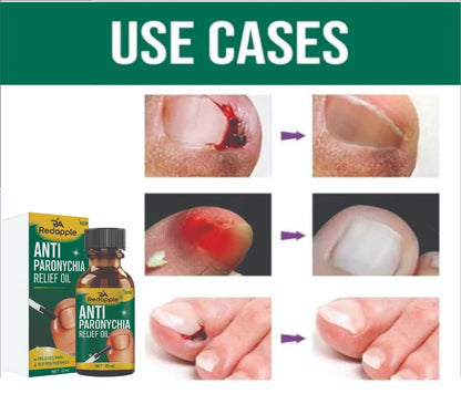 Rapid Relief Anti-Paronychia Nail Treatment Oil (20ml x 2) | Soothing Cuticle & Nail Infection Care